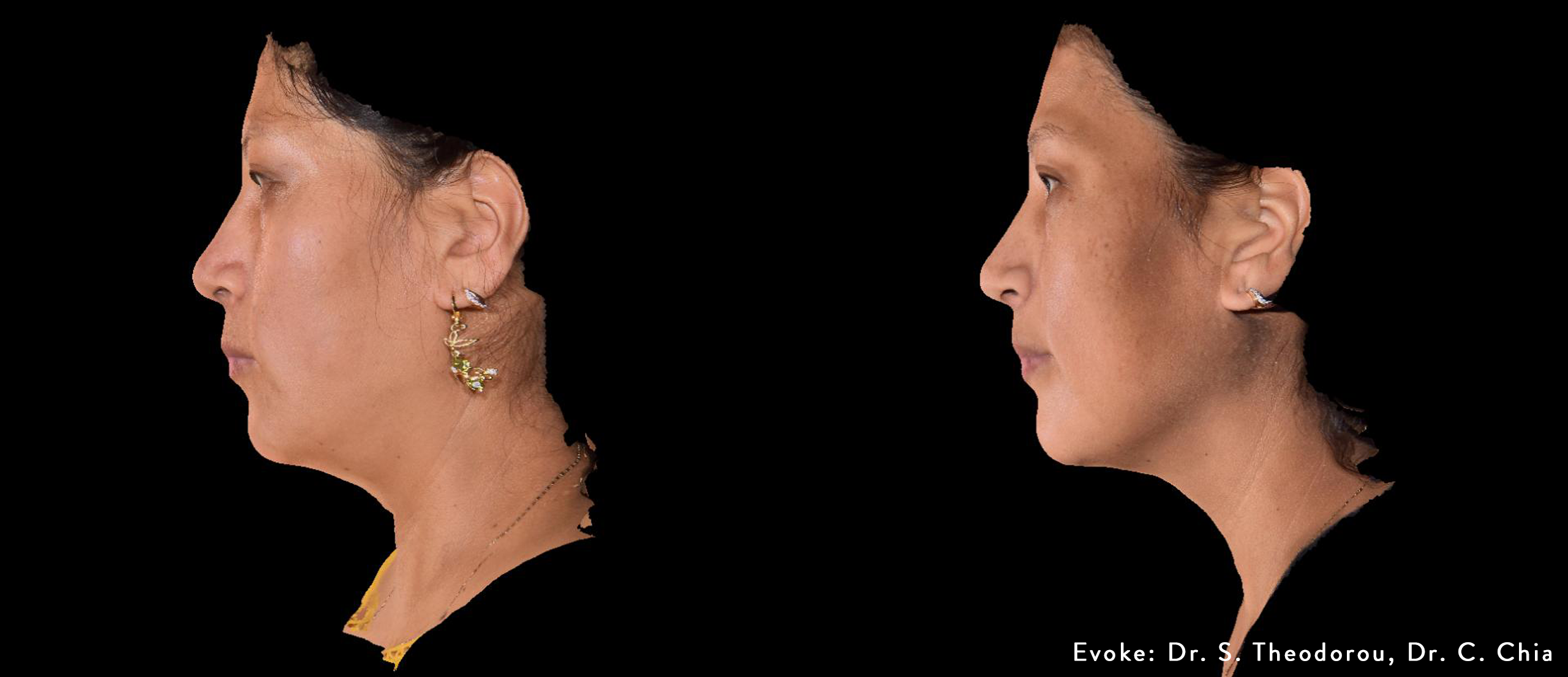 Evoke Face and Neck Contouring – DR. MARIE